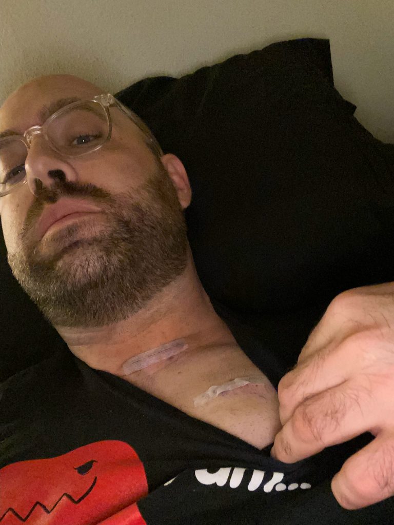 Tukayote lying down in clear-framed glasses, pulling back a black t-shirt collar to show two healed scars on his upper chest from his VNS implant